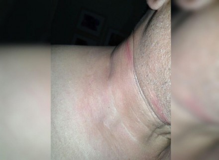 Ubatense ficou ferido no pescoço com linha de cerol (Foto: Ubatã Notícias)